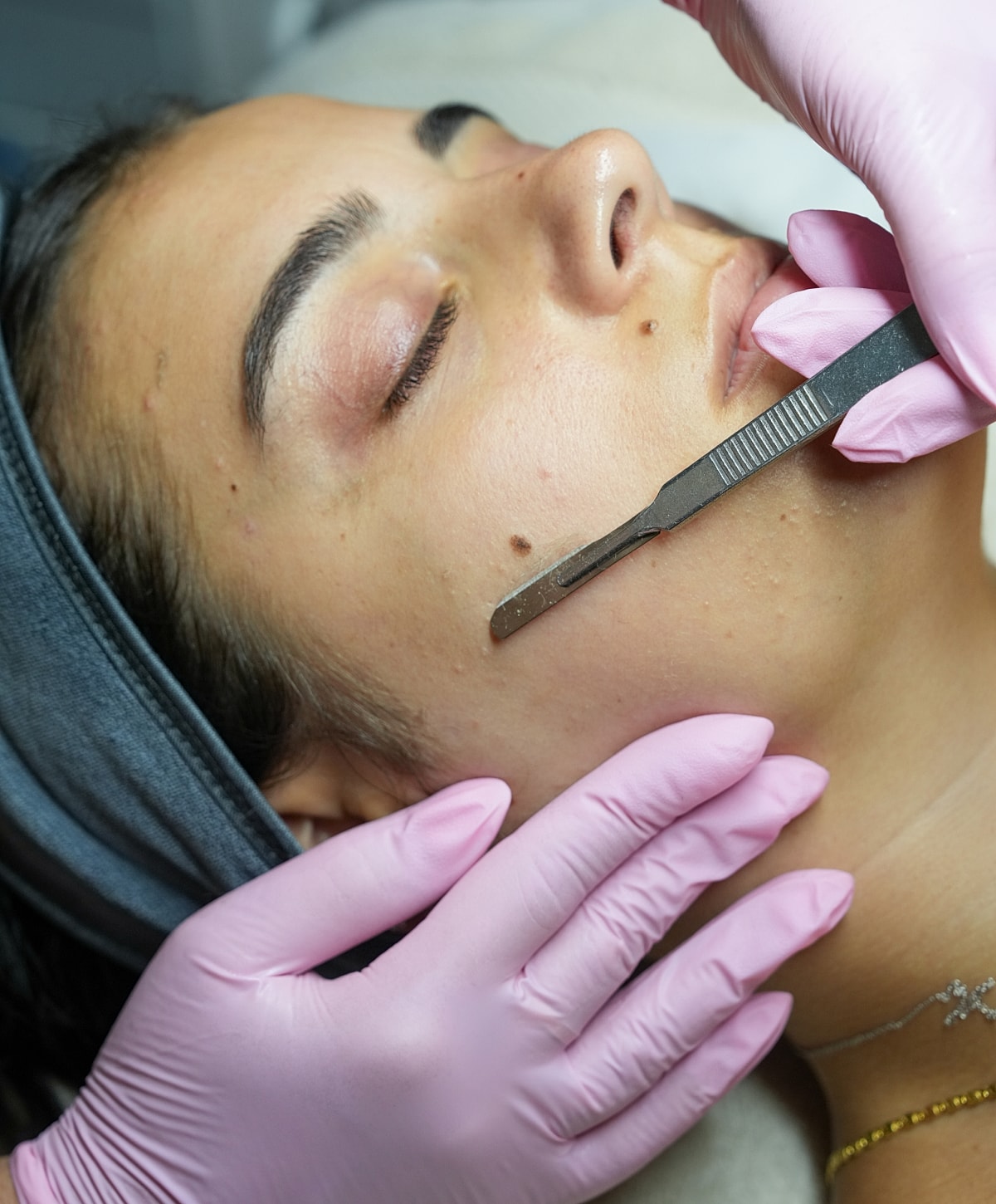 Woman undergoing facial treatment with a dermatome.