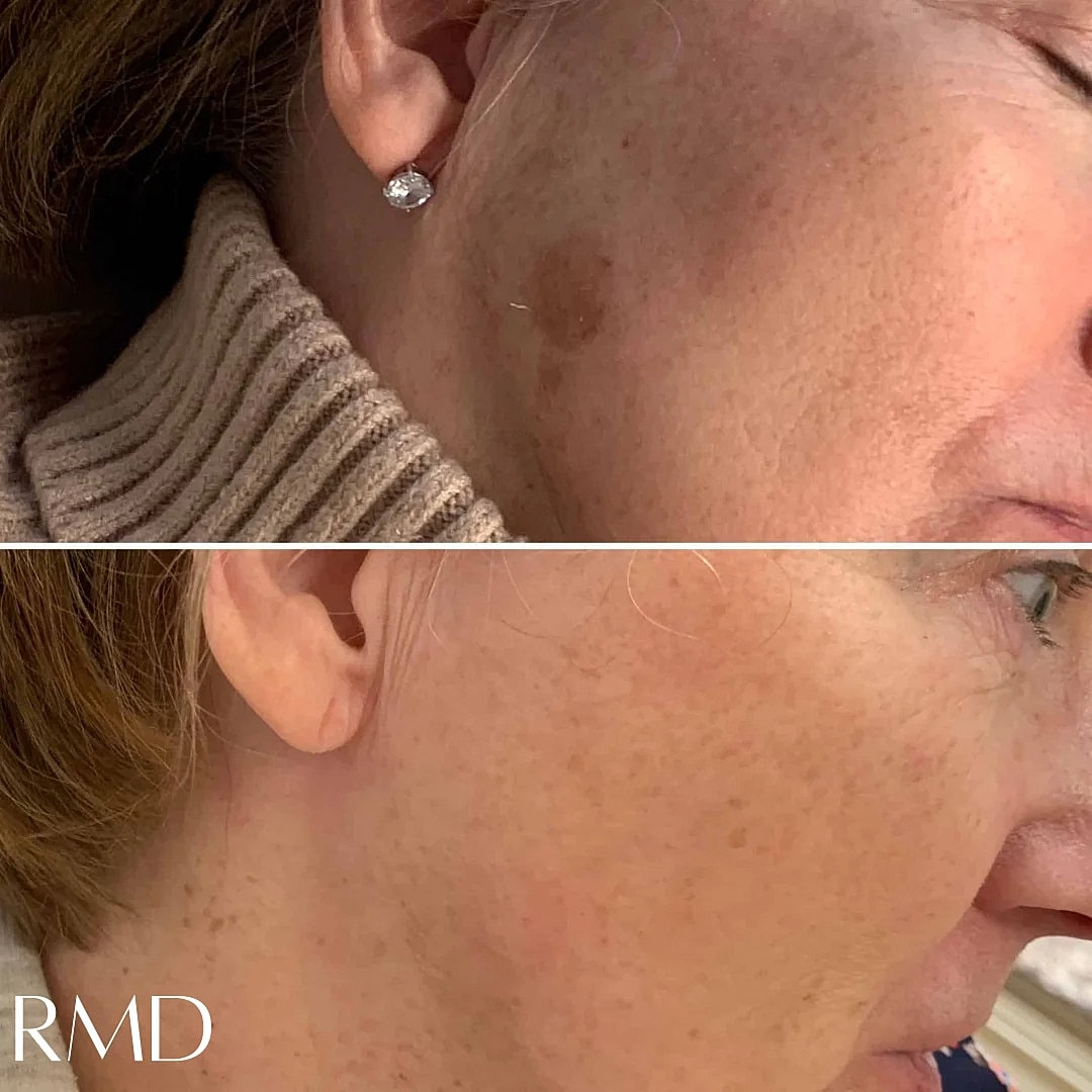 Laser Skin Resurfacing Before & After
