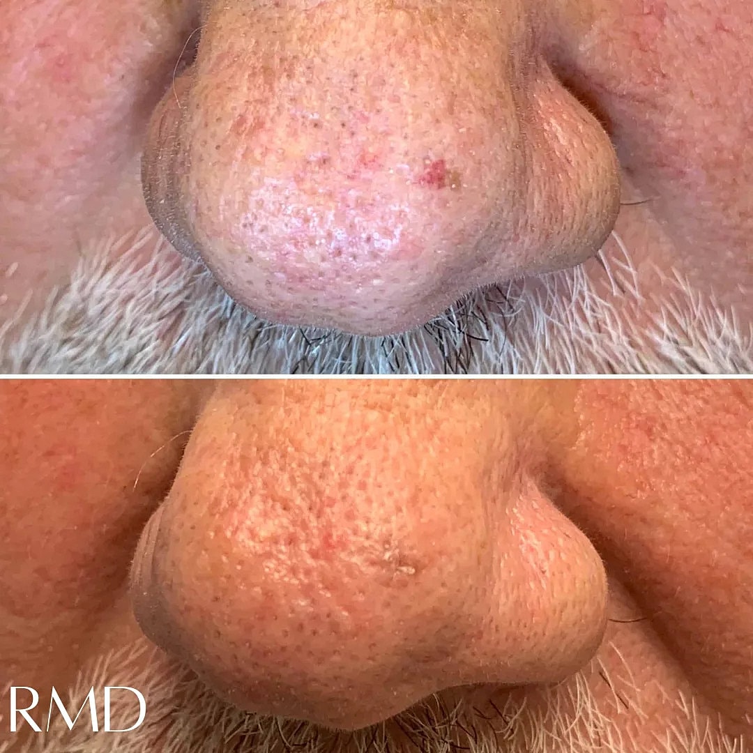 Laser Skin Resurfacing Before & After
