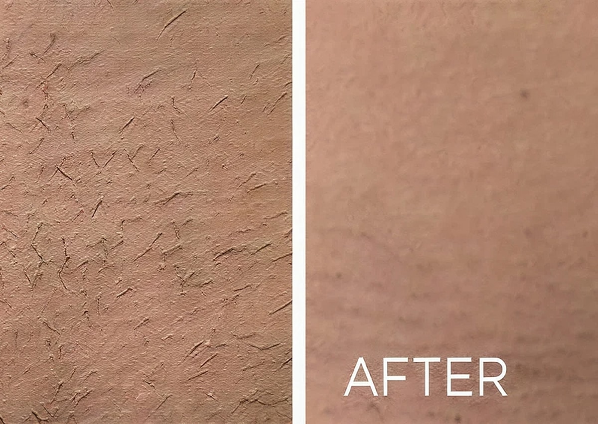Renovo Laser Hair Removal in Northborough MA | Best Medical Spa in Northborough, MA