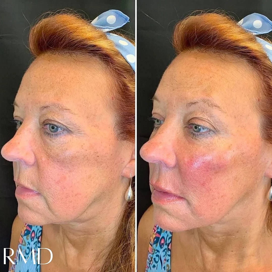 Dermal Fillers Before & After