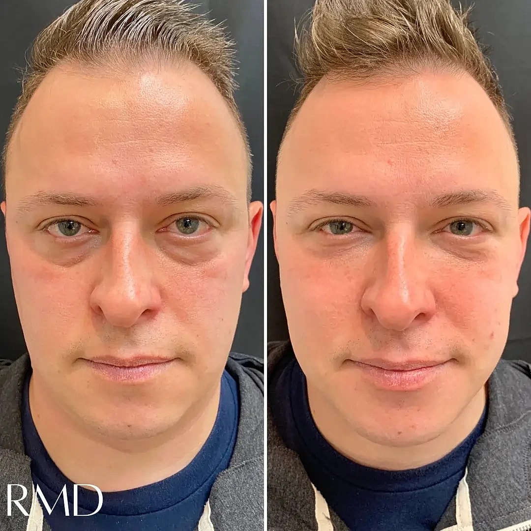 Dermal Fillers Before & After