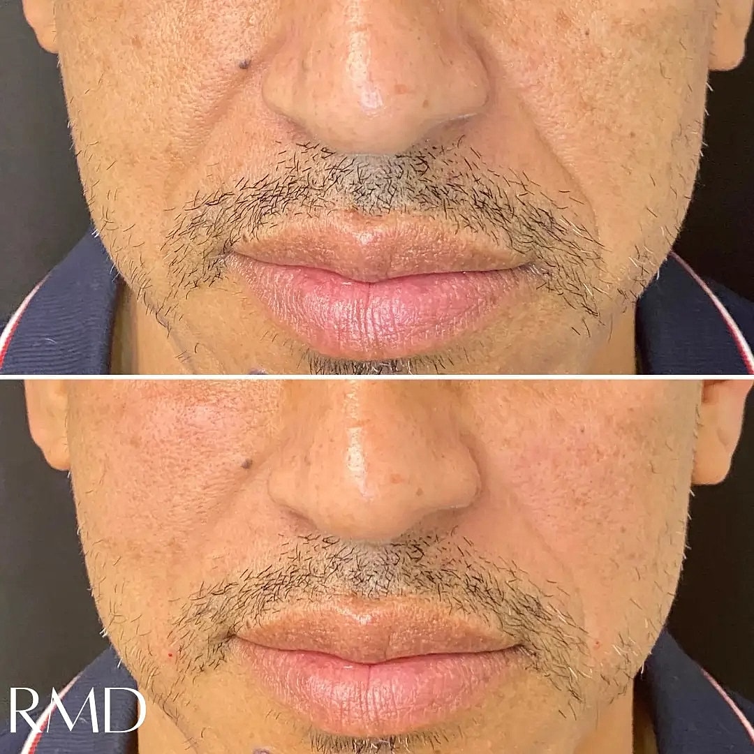 Dermal Fillers Before & After