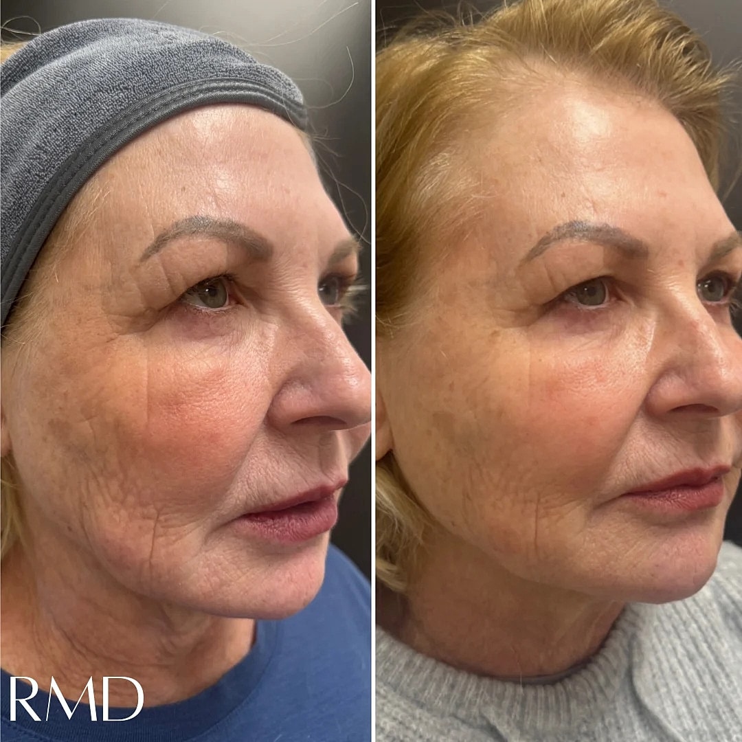 Dermal Fillers Before & After