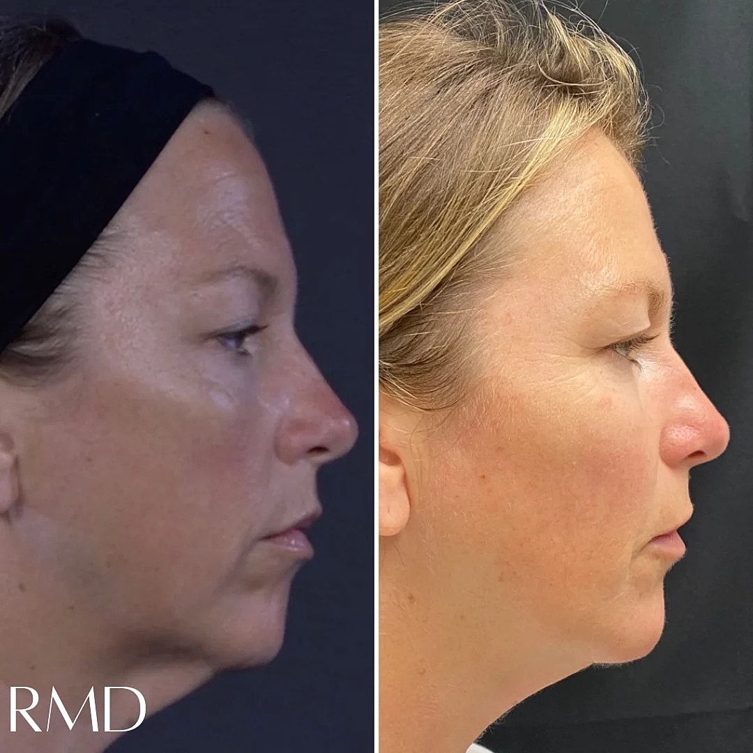 Dermal Fillers Before & After