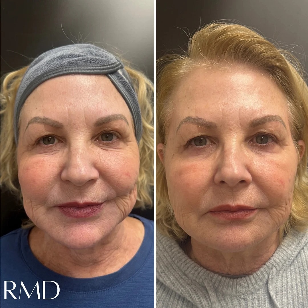 Dermal Fillers Before & After