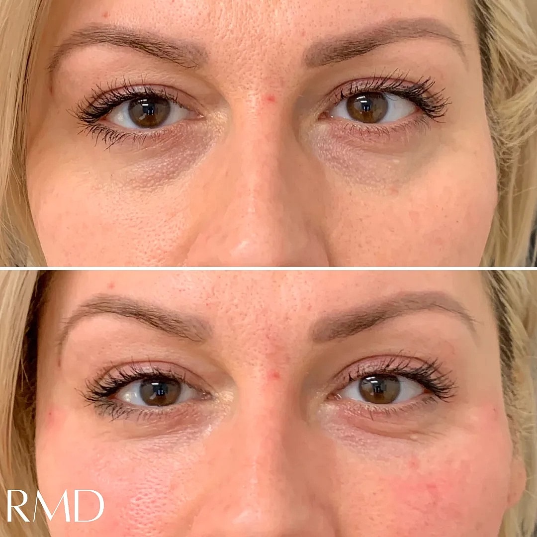 Dermal Fillers Before & After