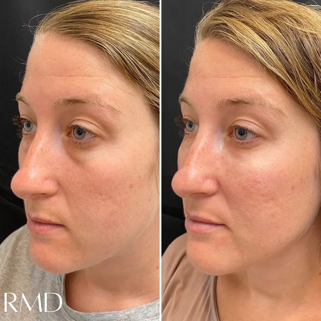 Dermal Fillers Before & After