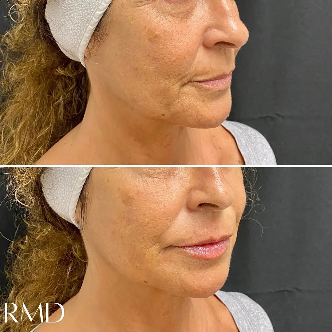 Dermal Fillers Before & After