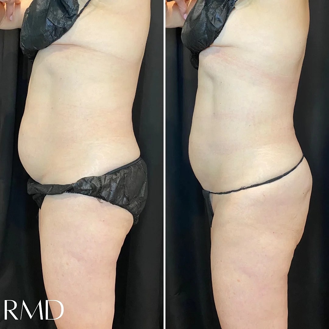 Coolsculpting Before & After