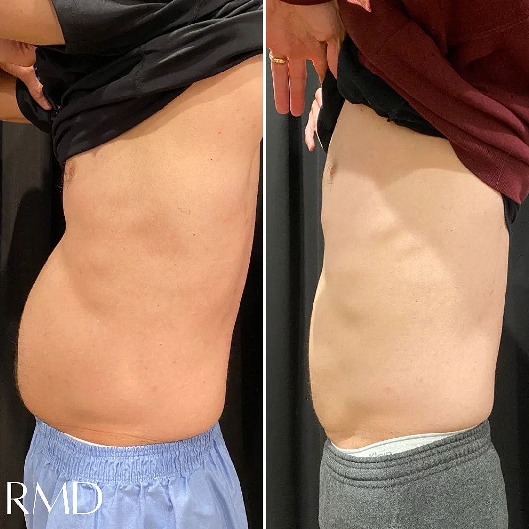 Coolsculpting Before & After