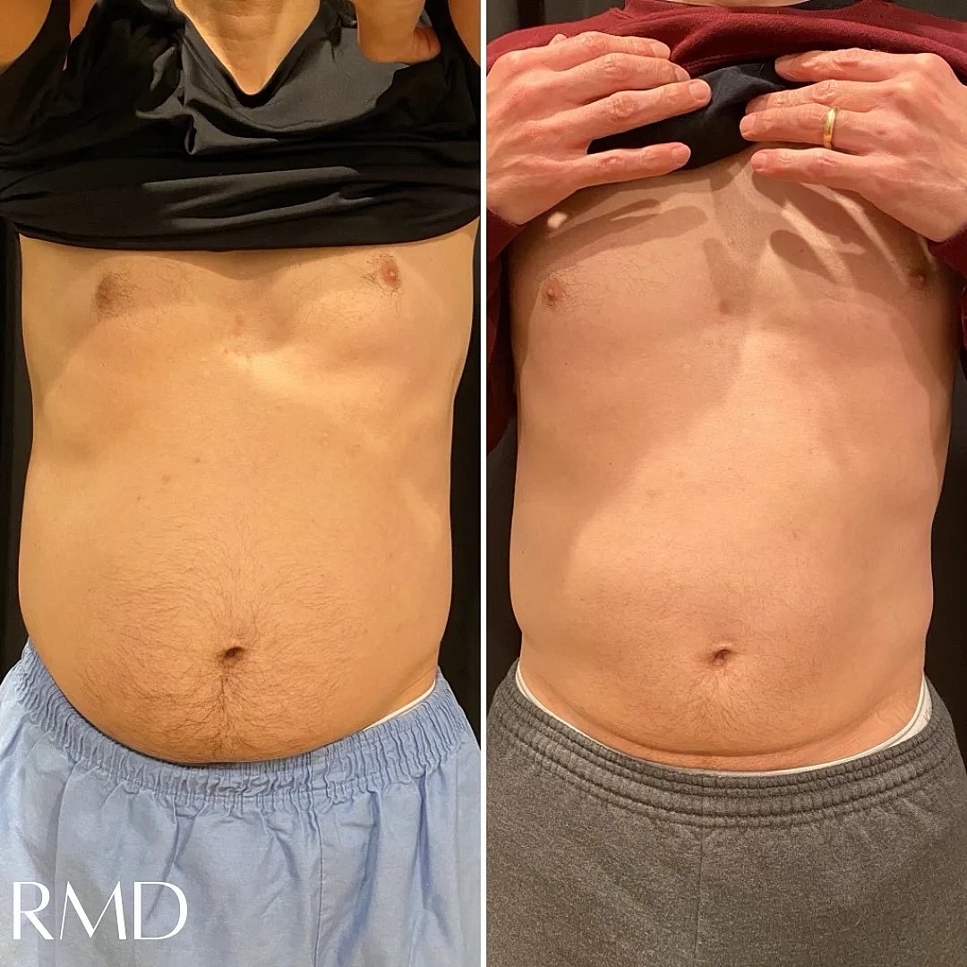 Coolsculpting Before & After