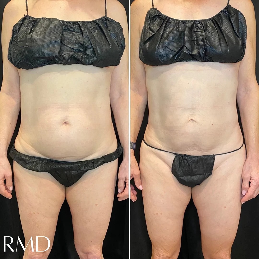 Coolsculpting Before & After
