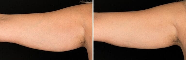 Coolsculpting Before And After ARM | ONORÉ in Northborough, MA