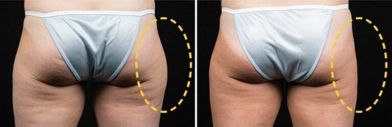 Coolsculpting Before And After Back | ONORÉ in Northborough, MA