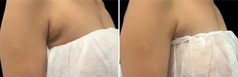 Coolsculpting Before And After Body | ONORÉ in Northborough, MA