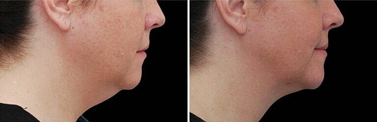 alt="Coolsculpting Before And After in Northborough, MA | ONORÉ"