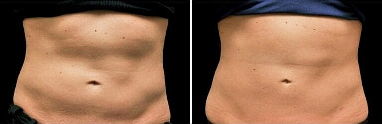 Coolsculpting Before And After Stomach in Northborough, MA | ONORÉ