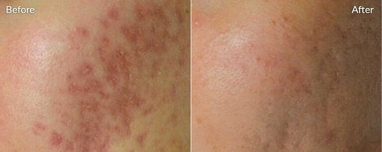 Skinpen-Microneedling-before-&-after in Northborough, MA