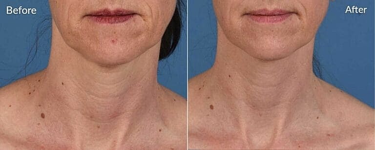 Skinpen-Microneedling-before-and-afterr in Northborough, MA