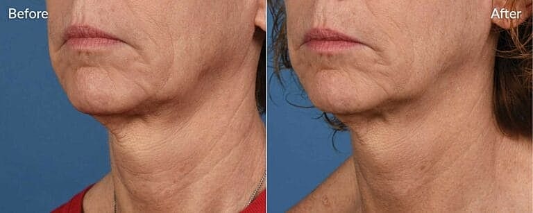 Skinpen Microneedling Before And After in Northborough, MA | ONORÉ