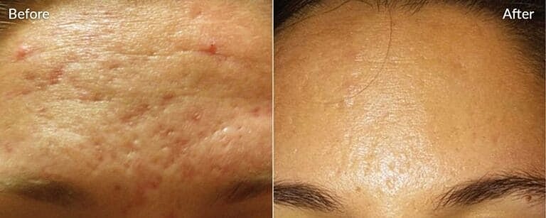 Skinpen Microneedling beforee and after in Northborough, MA