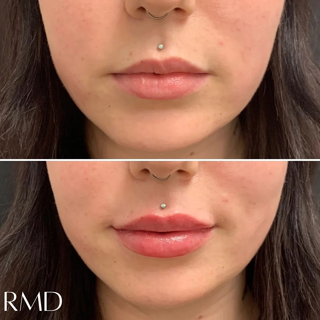 Lip Filler Before & After