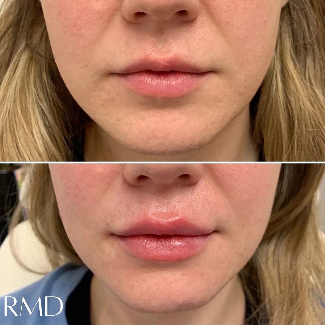 Lip Filler Before & After