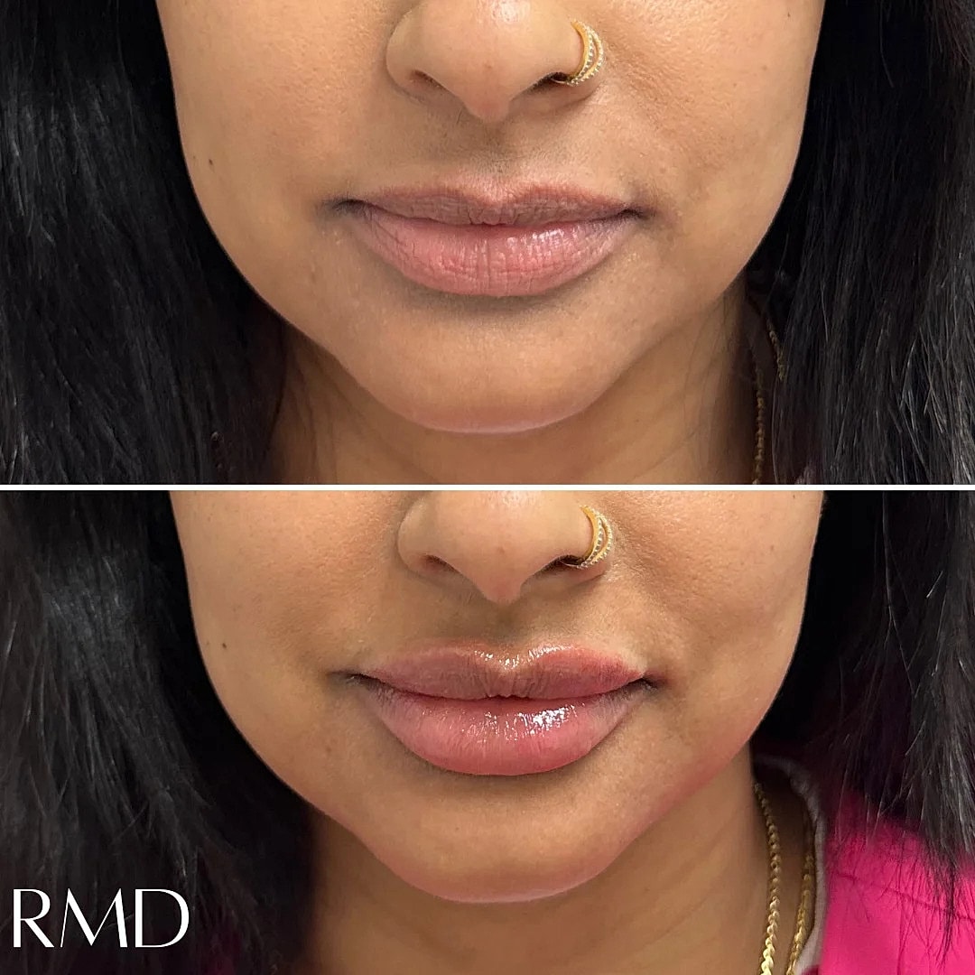 Lip Filler Before & After