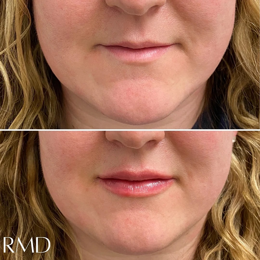 Lip Filler Before & After