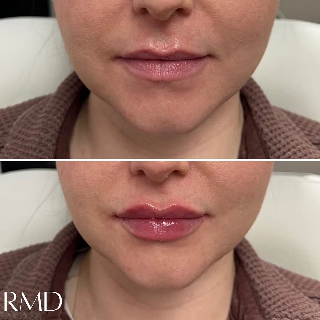 Lip Filler Before & After