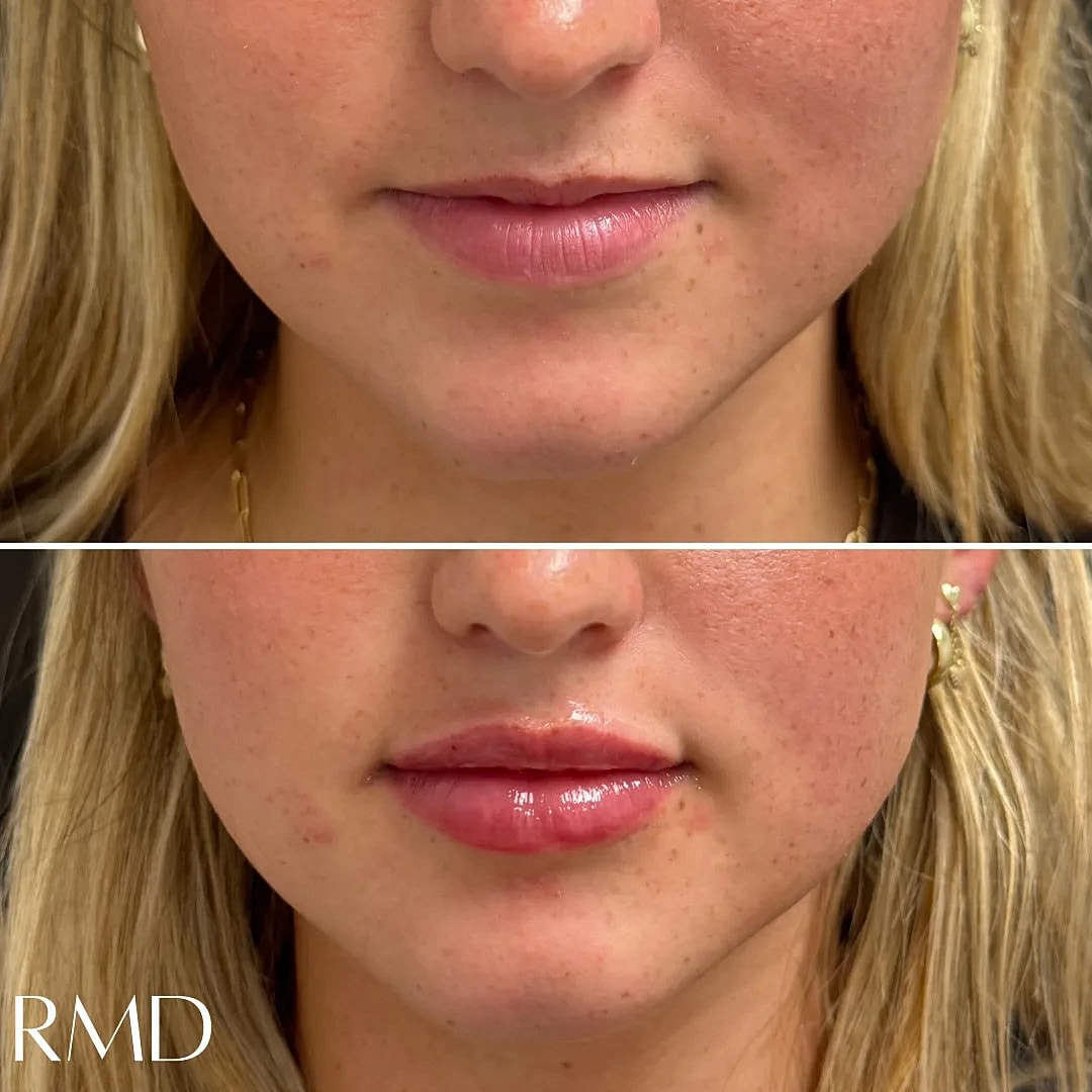 Lip Filler Before & After