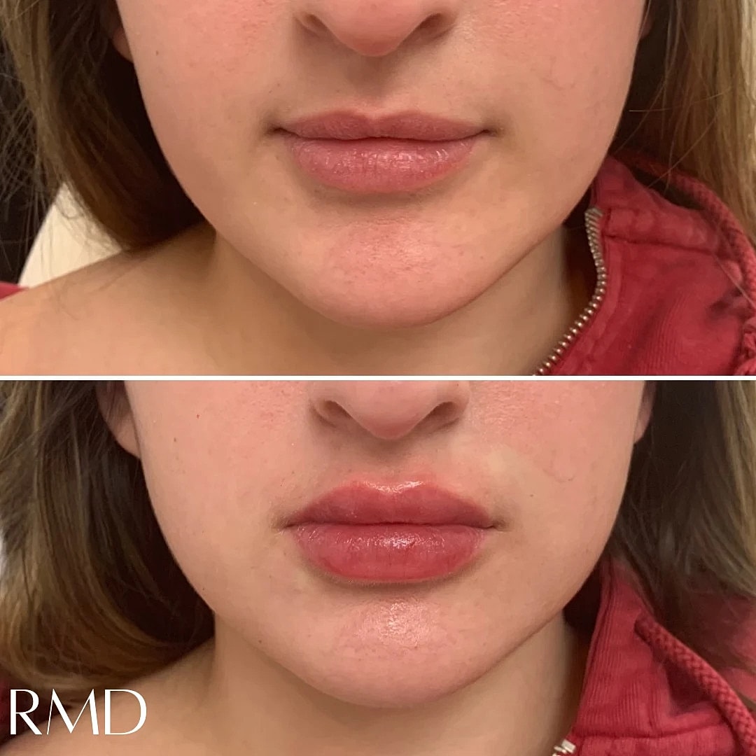 Lip Filler Before & After