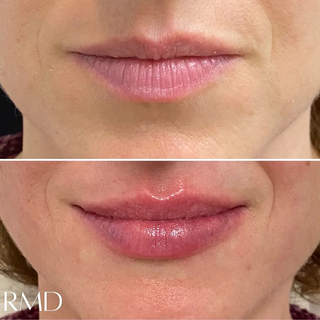 Lip Filler Before & After