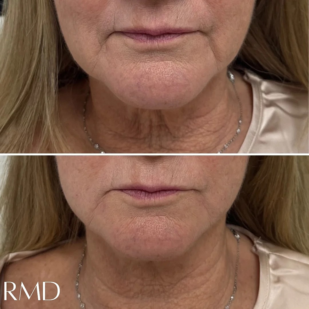 Lip Filler Before & After