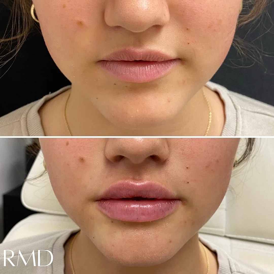 Lip Filler Before & After