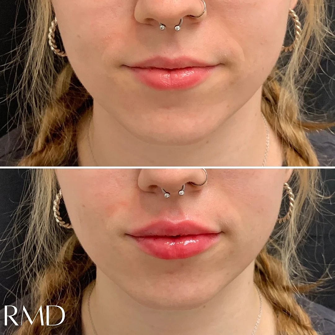 Lip Filler Before & After