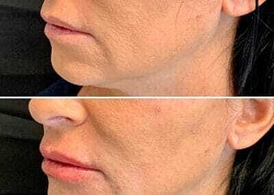 Lip Filler Before & After