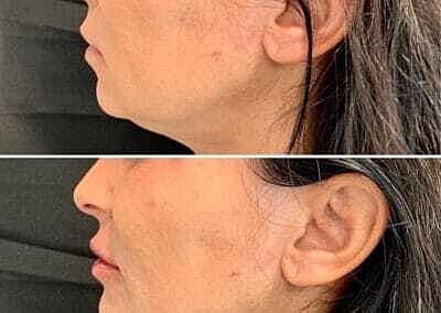 Lip Filler Before & After