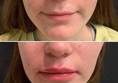 Lip Filler Before & After