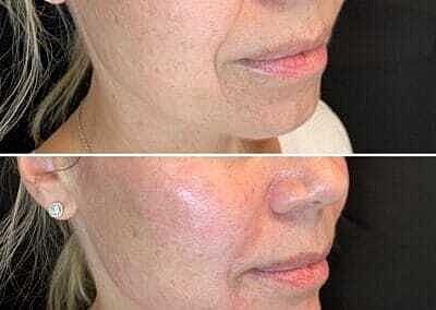 Lip Filler Before & After