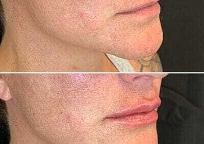 Lip Filler Before & After