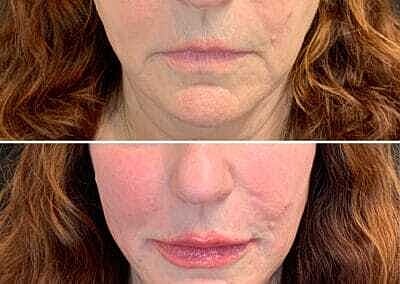 Lip Filler Before & After