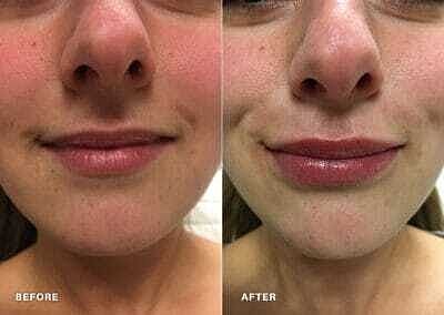Lip Filler Before & After