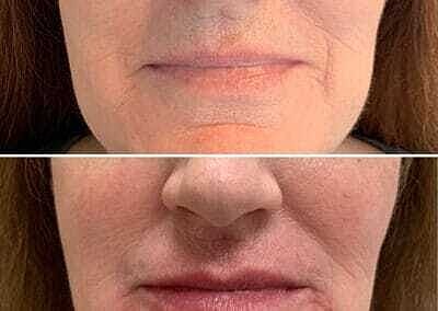 Lip Filler Before & After