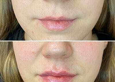 Lip Filler Before & After