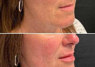 Lip Filler Before & After