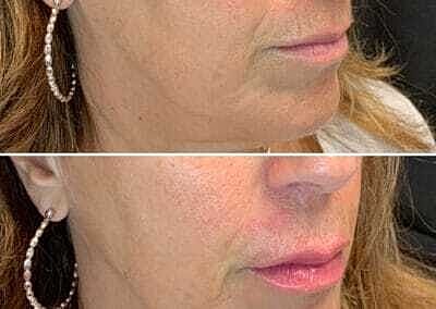 Lip Filler Before & After