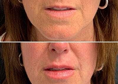 Lip Filler Before & After