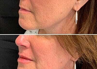 Lip Filler Before & After